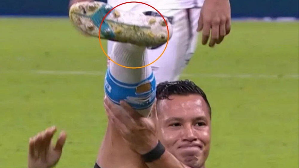 Cau thu Brazil binh than du co chan bi gay hinh anh