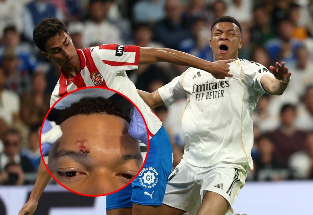 Mbappe gay lo lang hinh anh