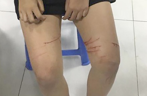 Thieu nu trinh bao bi ke xau rach dui bang dao lam hinh anh
