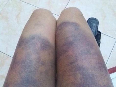 Co gai to bi ban trai Ha Noi nhot, danh dap bang gay sat hinh anh