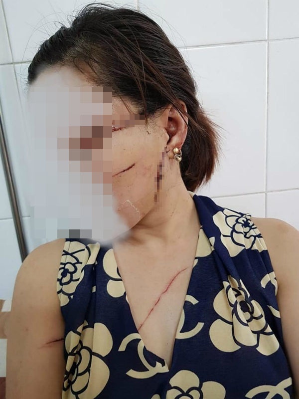 Rach mat, cat gan chan vo sau chuyen xuat khau lao dong hinh anh