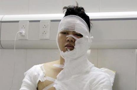 Nam sinh dien anh bi tat axit: 'Em tung nghi cuoc doi coi nhu bo di' hinh anh