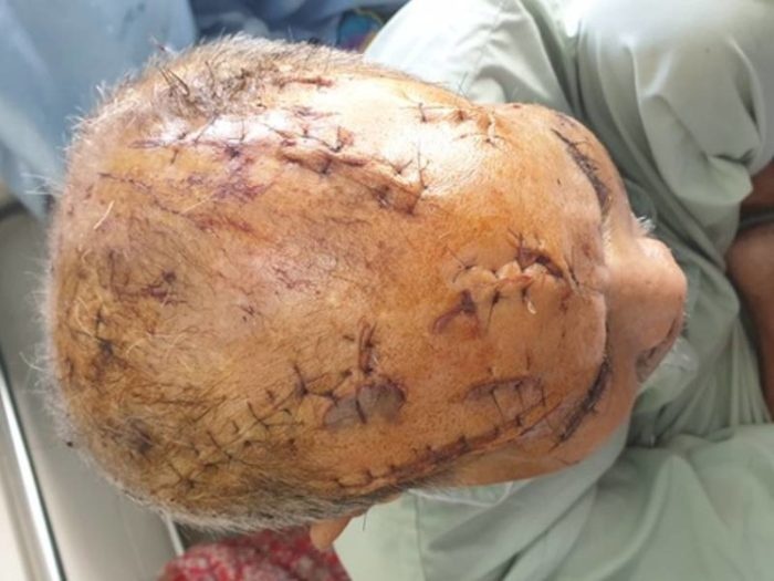 Vu cu ong 74 tuoi bi rach nat dau: Bat tam giam chau noi nan nhan hinh anh