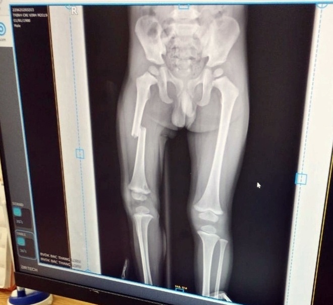 Dap gay xuong dui anh 1