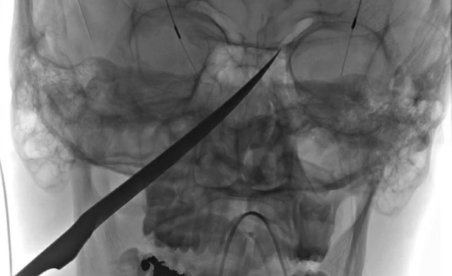 Cau be My 15 tuoi bi dao dam xuyen hop so song sot ky dieu hinh anh