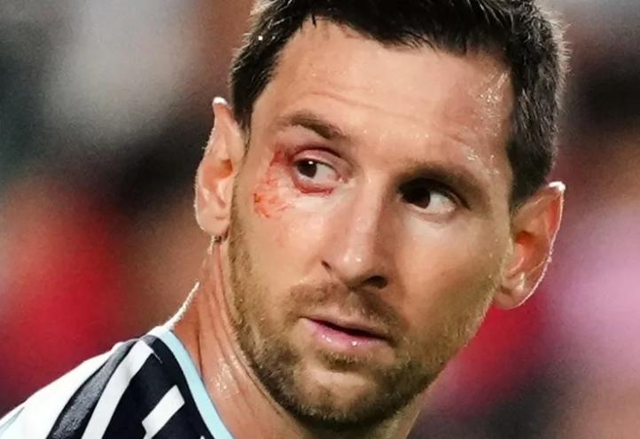 Mắt rướm máu của Messi