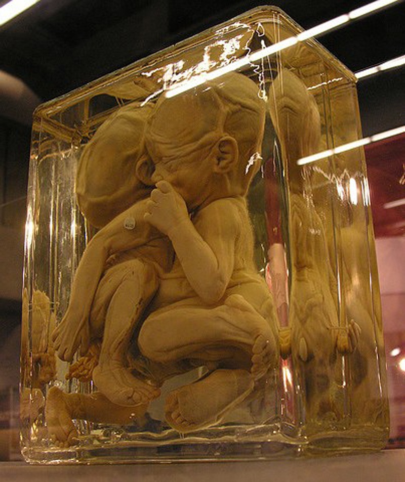 Bao tang dot bien y khoa kinh di tai My hinh anh