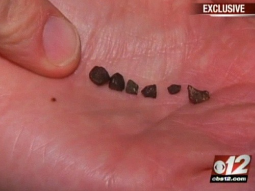 Thien thach roi trung dau be trai 7 tuoi hinh anh