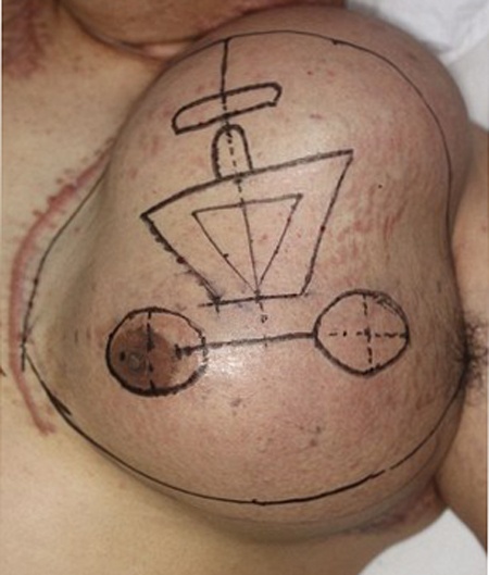 Cay mat moi tren nguc nguoi bi dien giat hinh anh