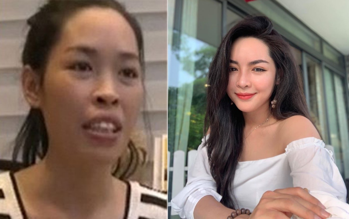 phau thuat tham my anh 1