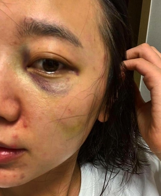 ca sĩ bị chồng đánh ảnh 1 ca si bi chong danh anh 1