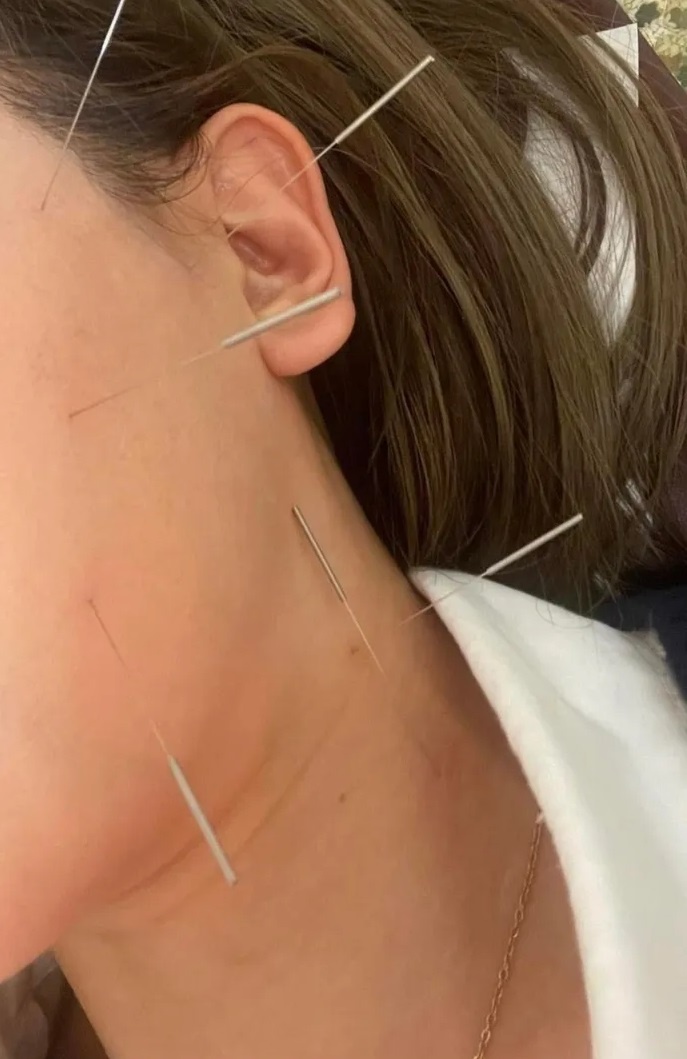 Hari Won liệt cơ mặt ảnh 2 Hari Won liet co mat anh 2