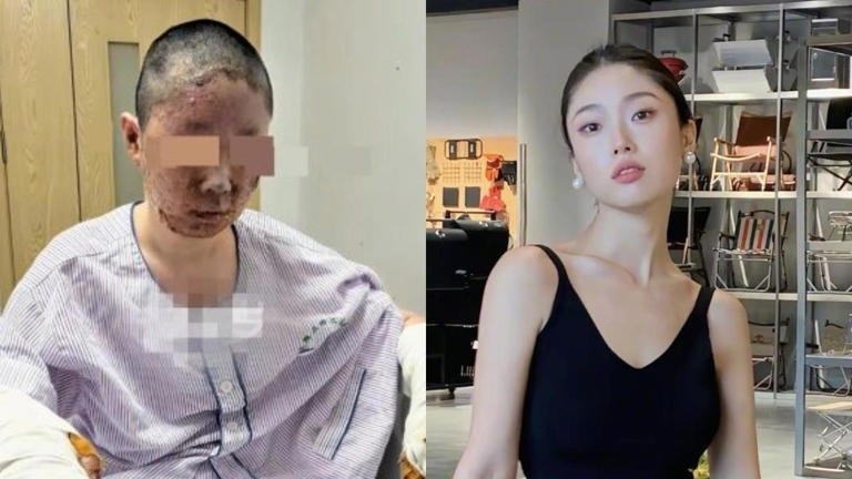 Nguoi mau Dong Dao bien dang khuon mat sau vu no kinh hoang hinh anh