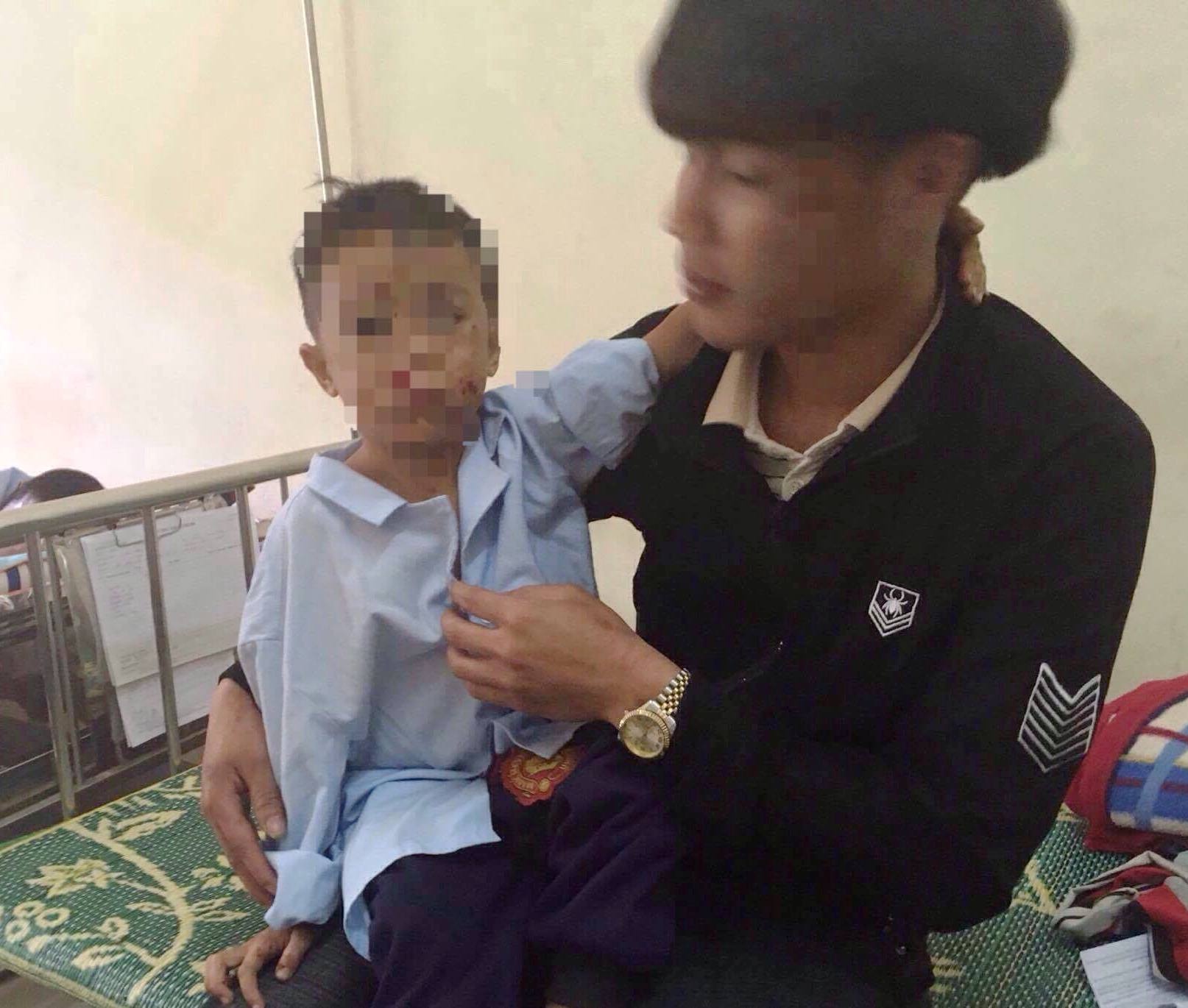 Hai anh em bi no nat tay khi dot pin dien thoai hinh anh