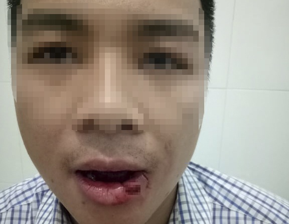 Gãy răng ảnh 2 Gay rang anh 2