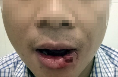 Thay giao nem thanh sat lam nhan vien toa gay 5 rang: 'Toi an han lam' hinh anh