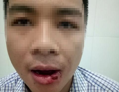 thầy giáo ném gãy răng nhân viên tòa ảnh 1 thay giao nem gay rang nhan vien toa anh 1