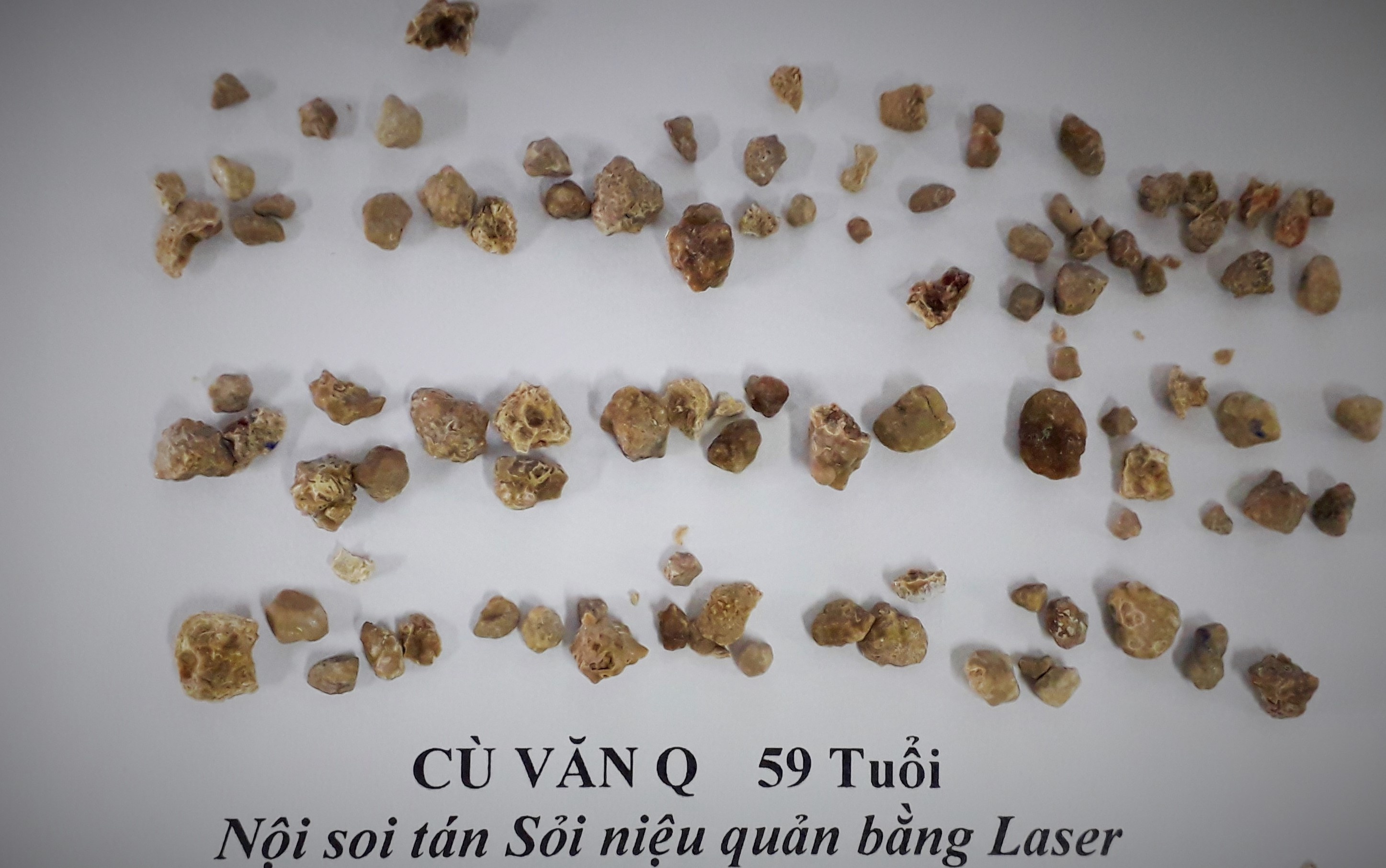 nội soi tia laser ảnh 1 noi soi tia laser anh 1