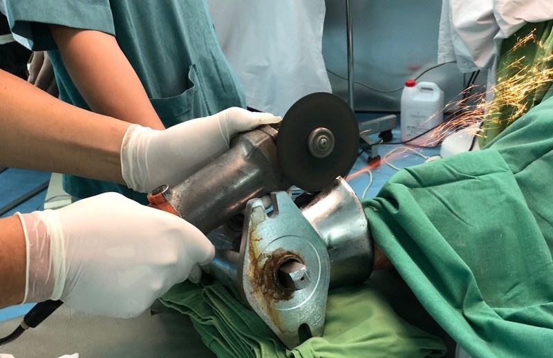 Nhan vien bep an bi may xay thit nghien nat ban tay hinh anh