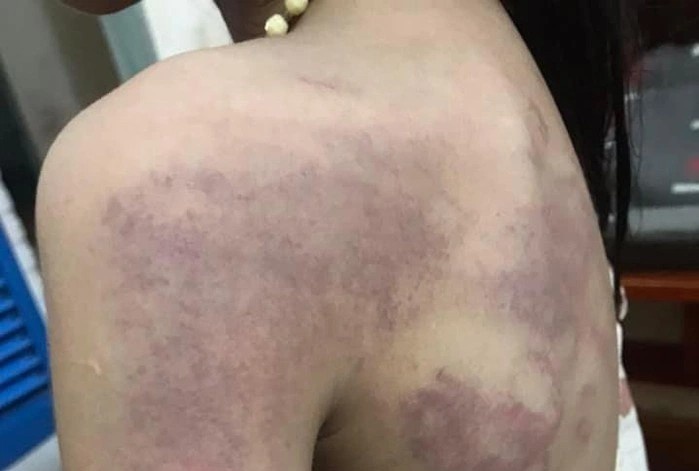 Tam dinh chi cong tac co giao danh bam vai, lung hoc sinh lop 3 hinh anh