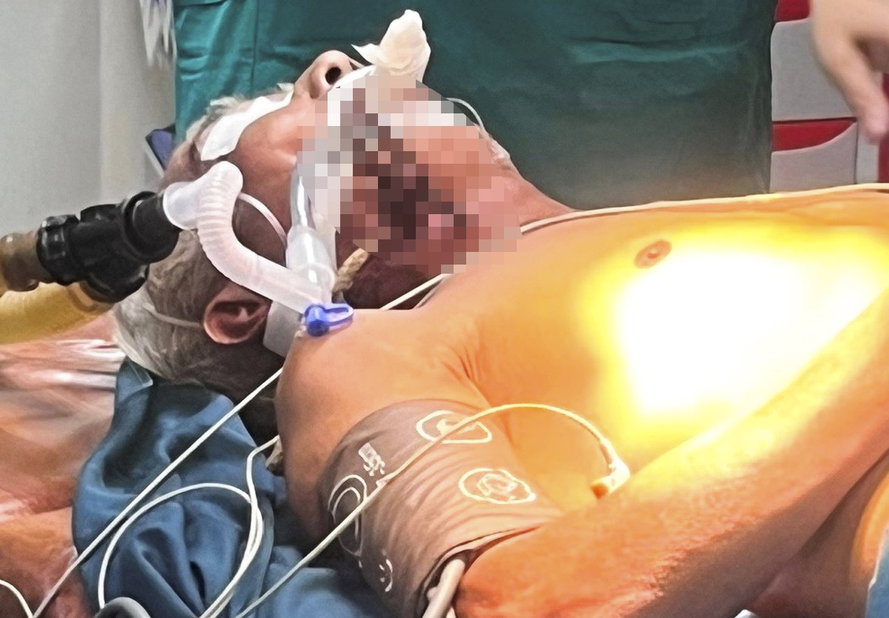 Nguoi dan ong bi thanh sat dai 30 cm dam xuyen co hinh anh