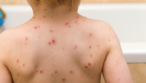 TP.HCM: Nhieu tre em nhap vien vi benh thuy dau hinh anh