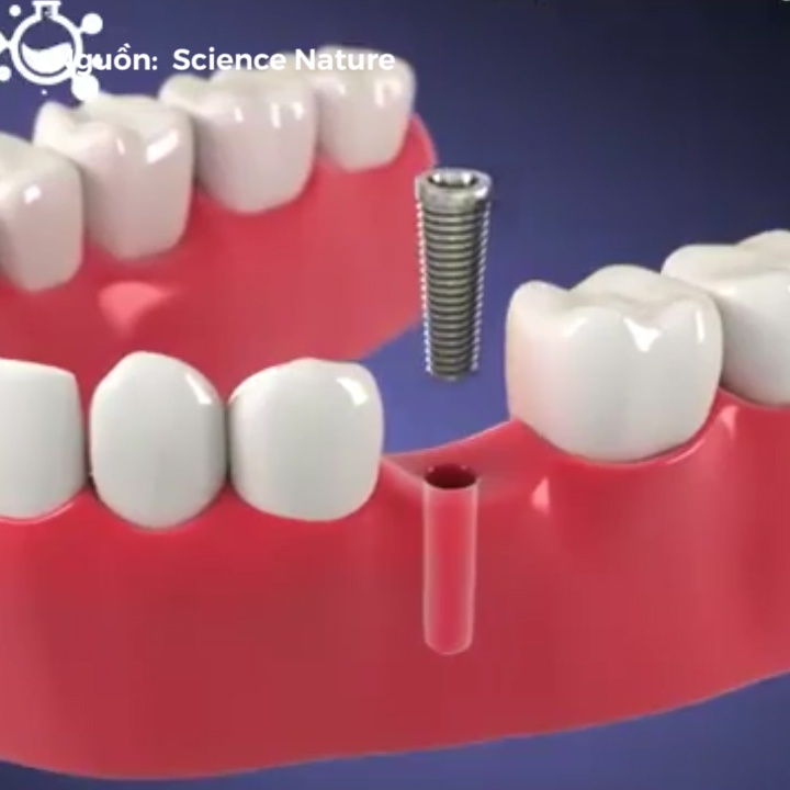 Mo phong mot so qua trinh lam dep cho rang mieng hinh anh