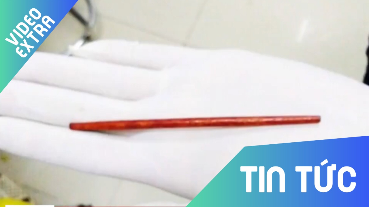 Nhap vien do vuong dua, kep toc trong co the nguoi hinh anh