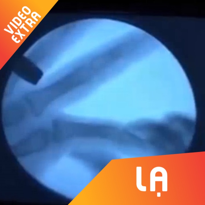 Video X-quang khi be cac khop ngon tay hinh anh