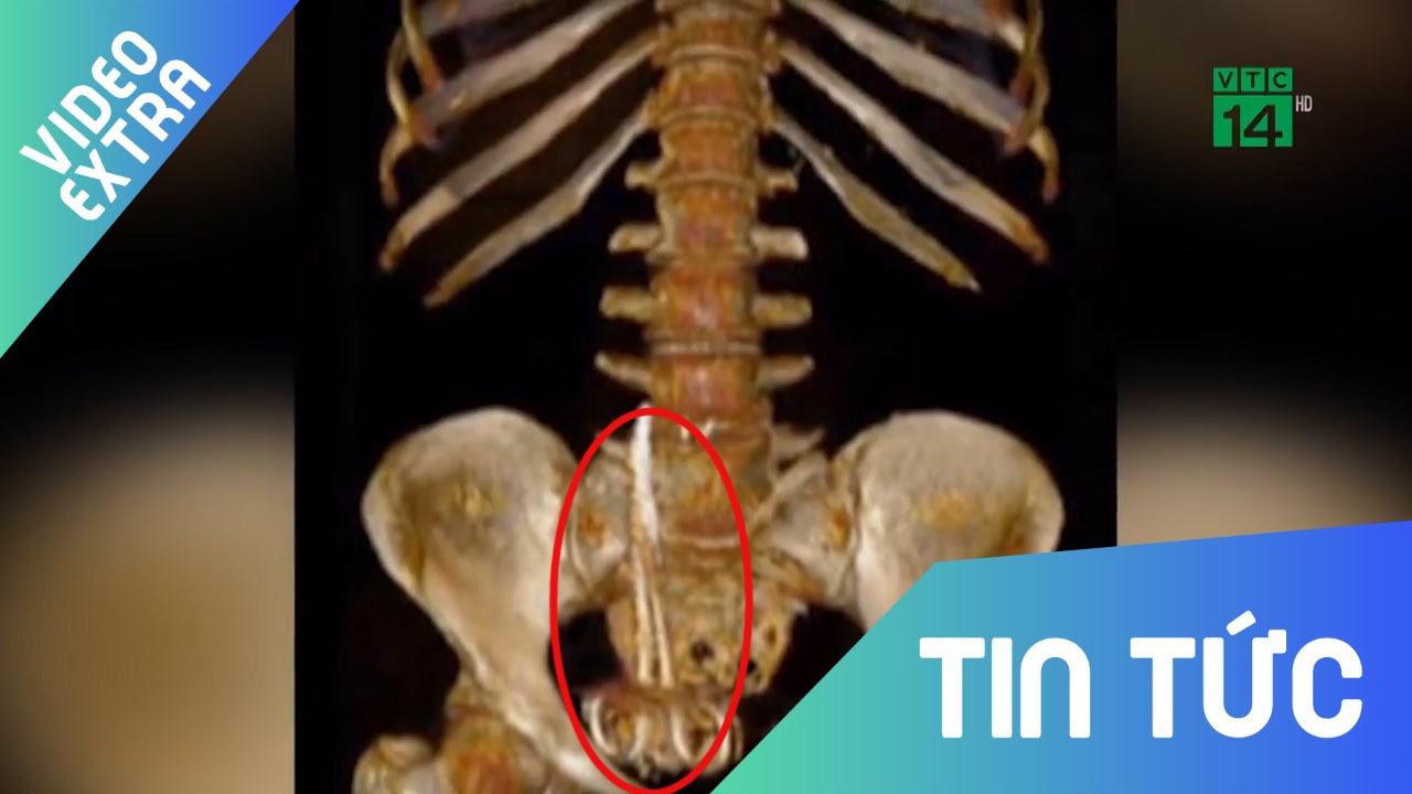 Tuong bi ung thu, hoa ra co chiec keo dai 15cm nam trong bung 6 thang hinh anh