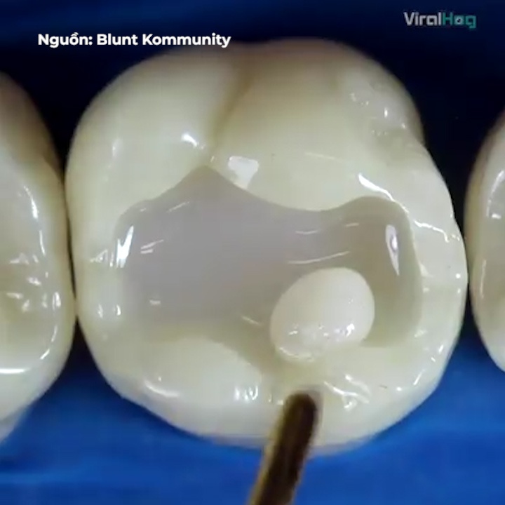 Can canh quy trinh phuc hoi rang hu hinh anh