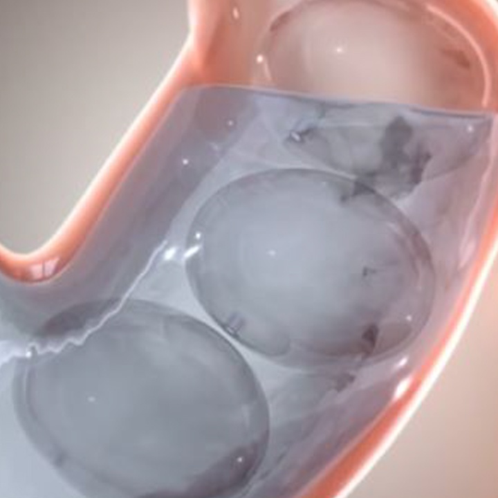 Phat minh giam can hieu qua bang he thong qua bong hoi hinh anh