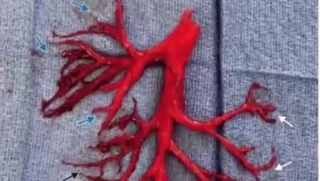 Su that benh nhan dang dieu tri tim thi ho ra ca phoi hinh anh