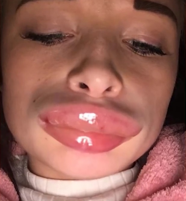 Nu y ta sung hup moi vi tiem thuoc lam day tai nha hinh anh