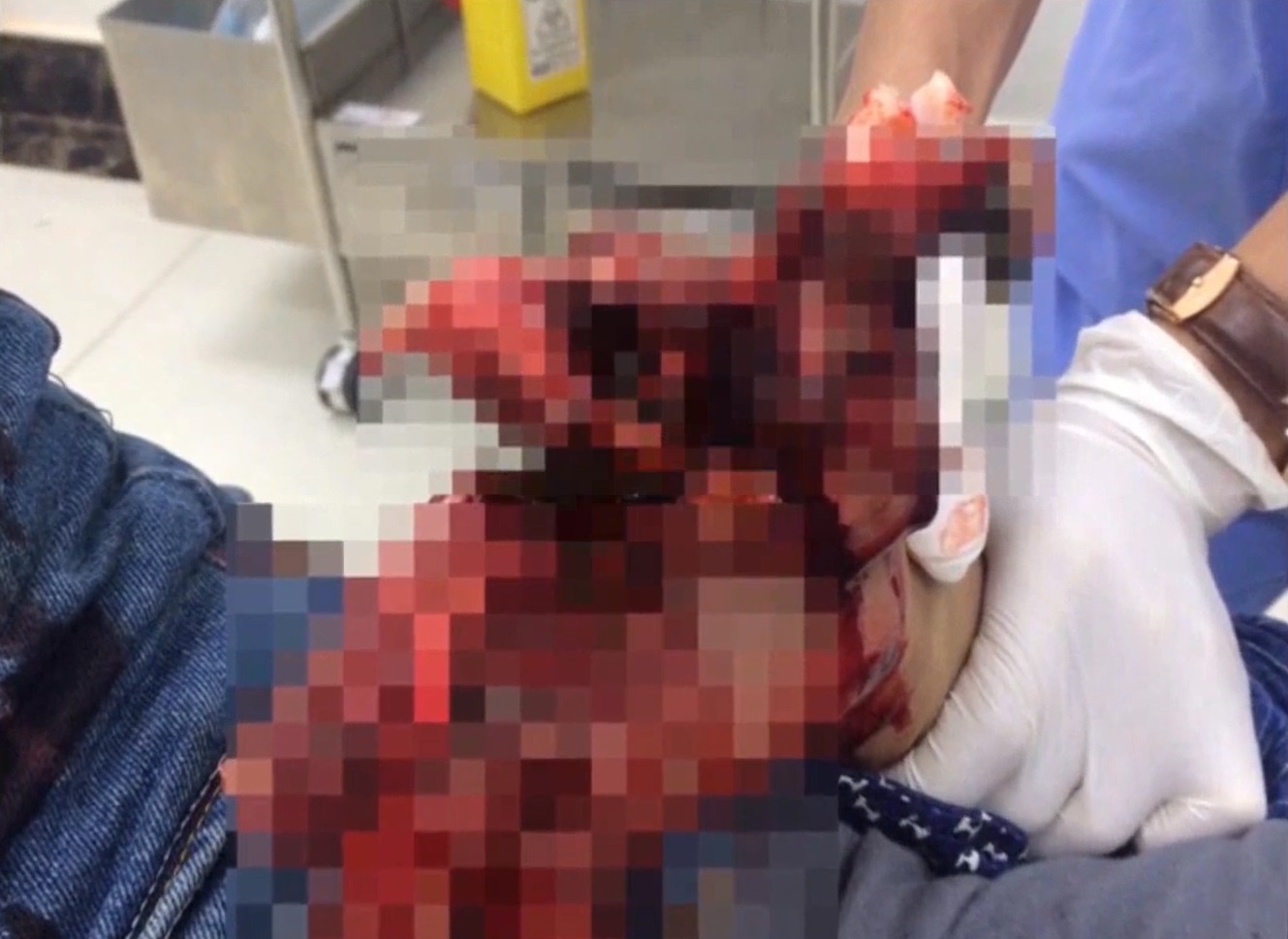 Nam thanh nien dap nat ban tay vi choi phao hinh anh