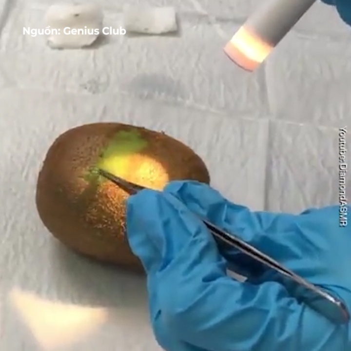 Bac sy thuc tap phau thuat tren trai kiwi nhu co the nguoi hinh anh