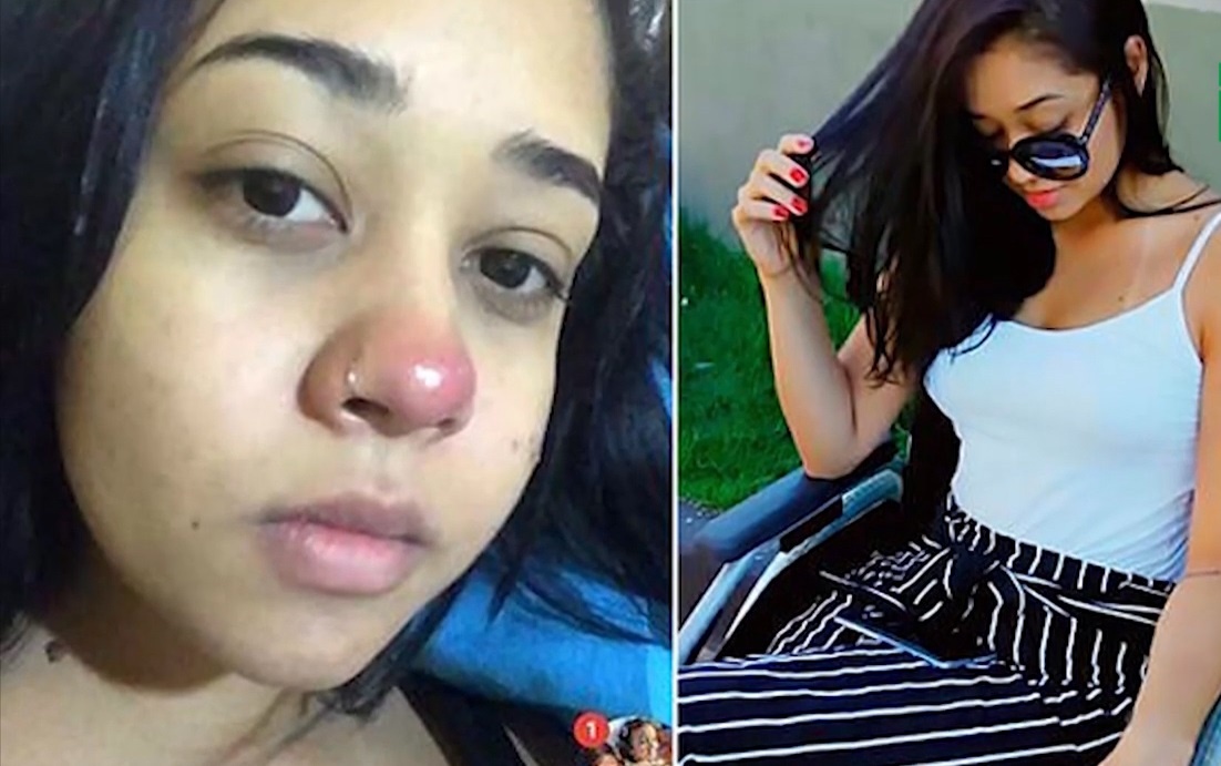 Xo khuyen mui bi nhiem trung, thieu nu liet 2 chan hinh anh