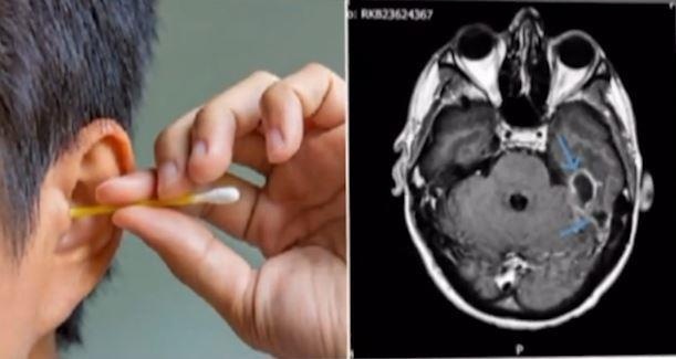 Ngoay tai bang tam bong, nguoi dan ong bi nhiem trung nao chet nguoi hinh anh