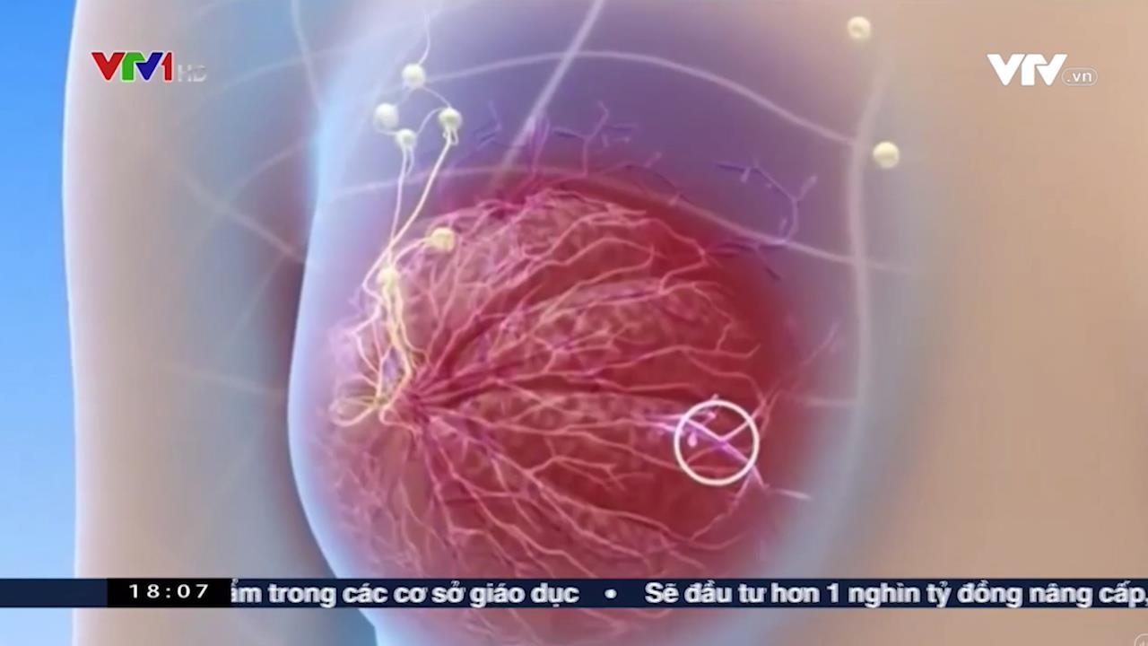 Phuong phap phau thuat u vu moi duoc ap dung hinh anh