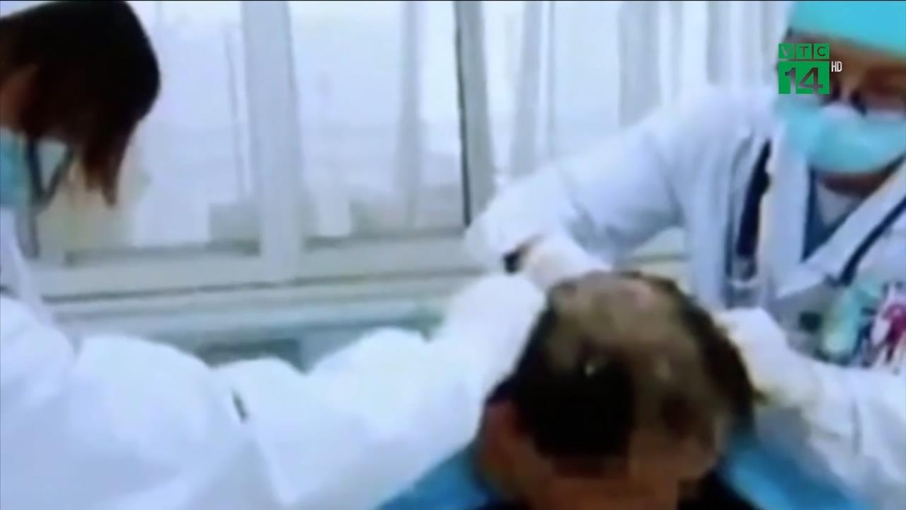 Goi dau bang thuoc tru sau, nguoi dan ong suyt mat mang hinh anh