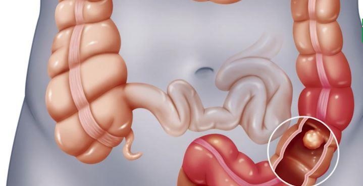 Bac si loi ca lang mang tuoi ra khoi ruot benh nhan hinh anh