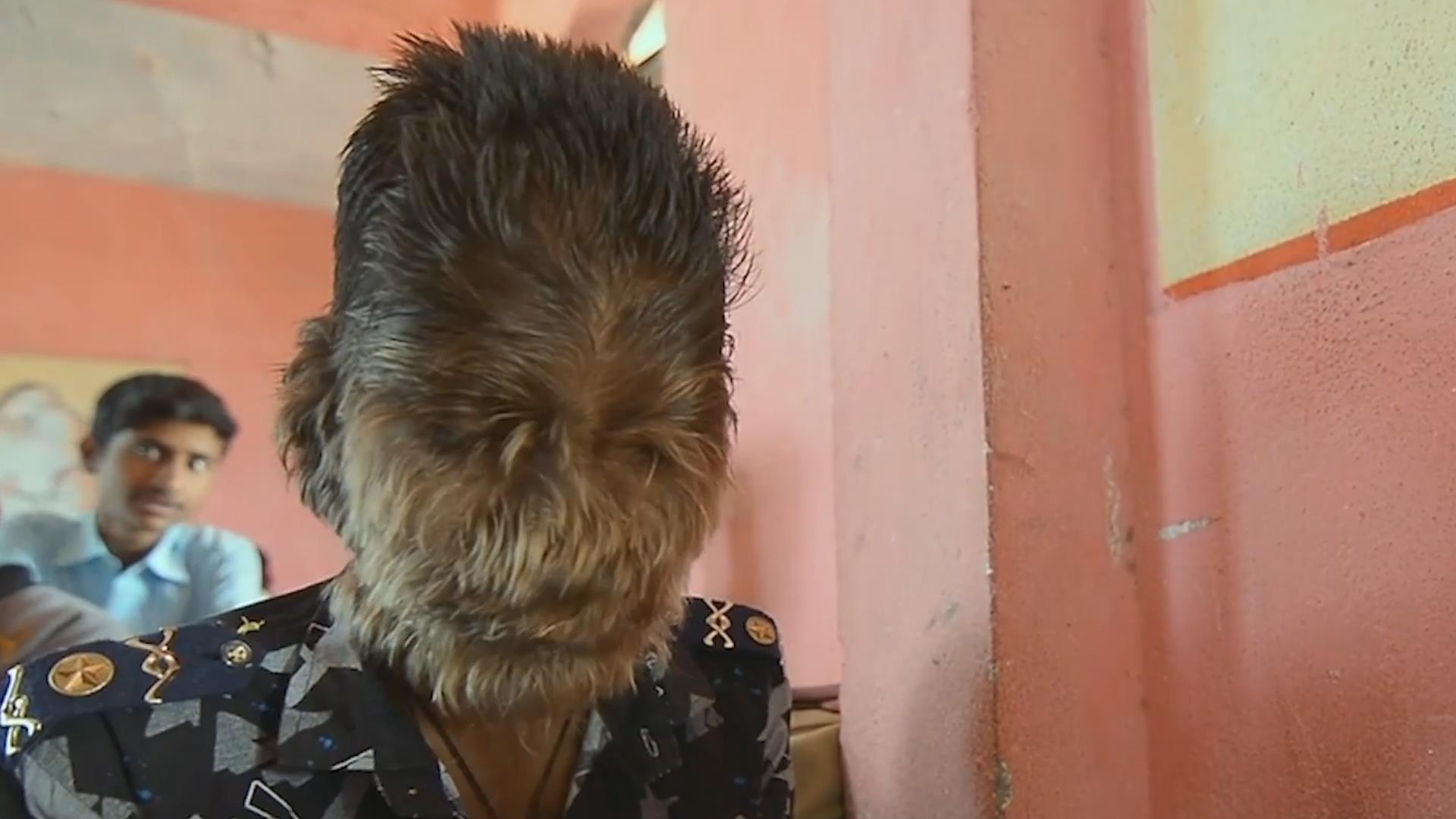 Cau be 'nguoi soi', mac benh hiem khien long la moc khap mat hinh anh