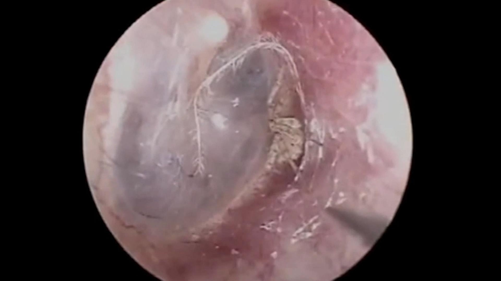 Gap nhen lam to ben trong tai nguoi dan ong hinh anh