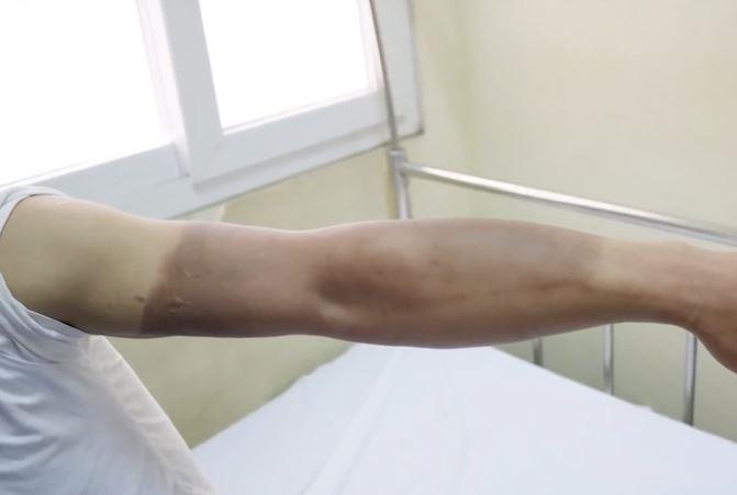 Dung bat lua dot chum bong bay, 4 thanh nien nhap vien vi bong nang hinh anh