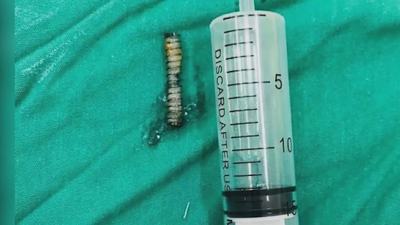 Mo qua trung do choi, be trai o TP.HCM bi lo xo ban vao phoi hinh anh