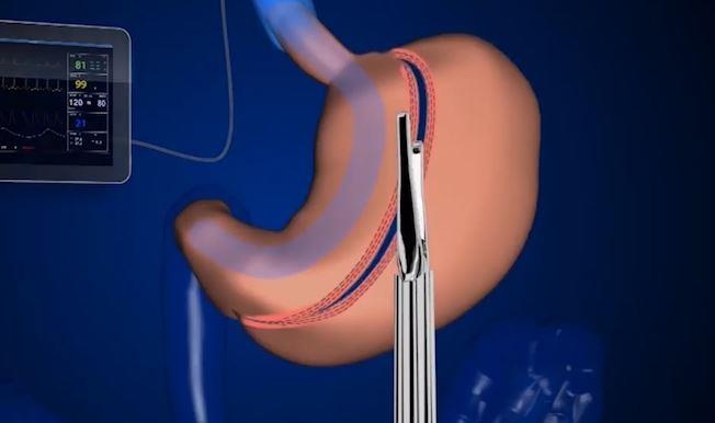 Co gai phai cat bot da day de giam can nhanh hinh anh