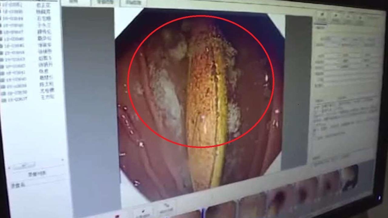 Bac sy lay ban chai 14 cm ra khoi da day cua benh nhan Trung Quoc hinh anh