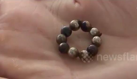 Bac si lay ra 10 vien bi sat tu bung be trai 1 tuoi hinh anh