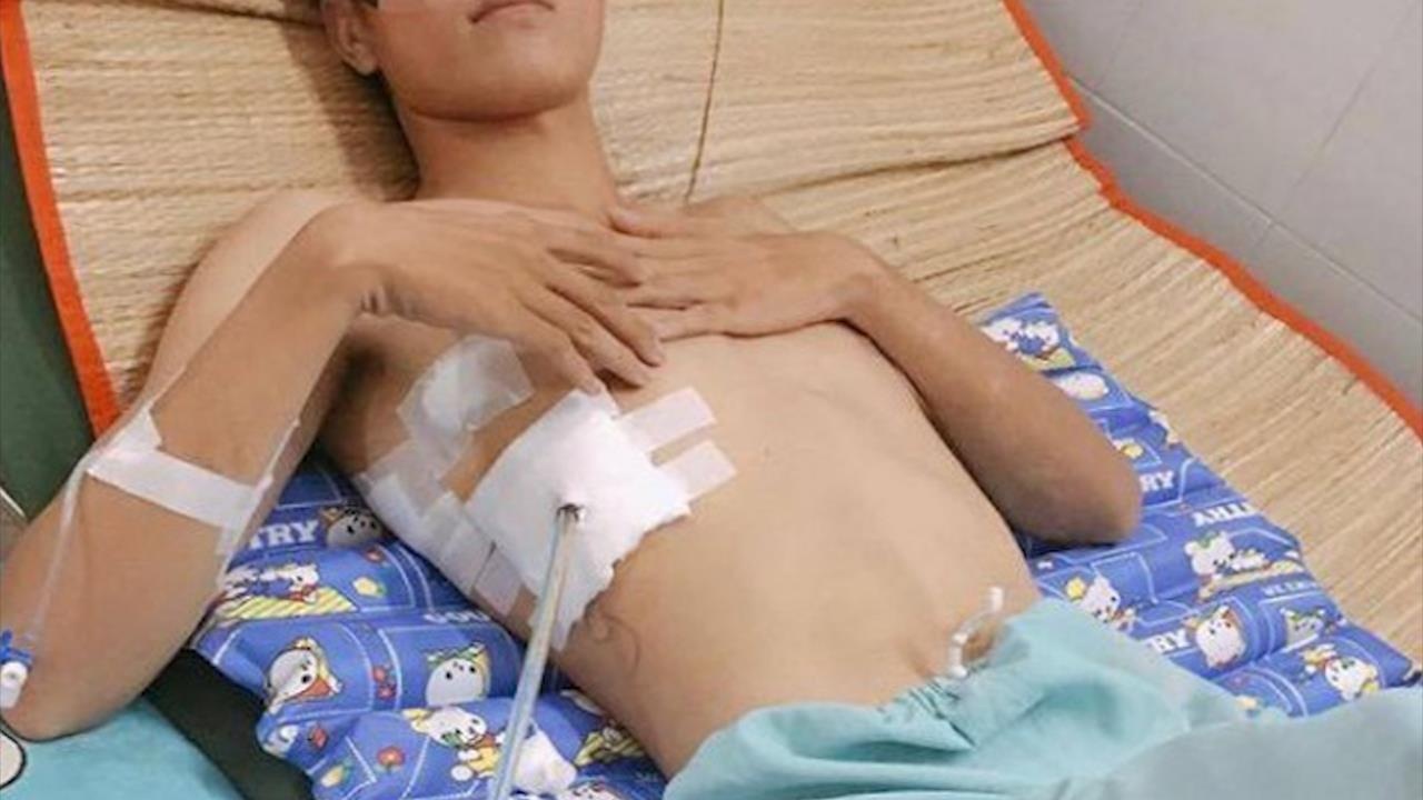 Hut thuoc suot 6 nam, benh nhan phai phau thuat 3 lan trong 10 ngay hinh anh