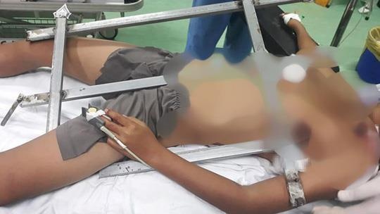 Roi tu cay cao, be trai bi hang rao sat dam xuyen nguc hinh anh